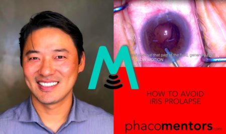 How to avoid iris prolapse – Takashi Nakano